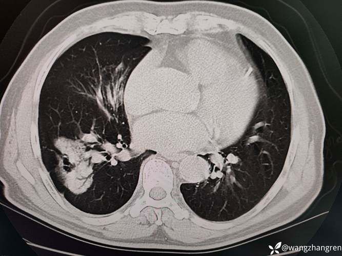 沙区现有死亡病例25例/沙区ume