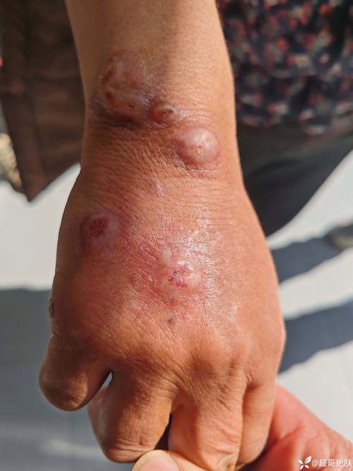 陇南近期新增感染趋势反弹:陇南新增一例疑似病人
